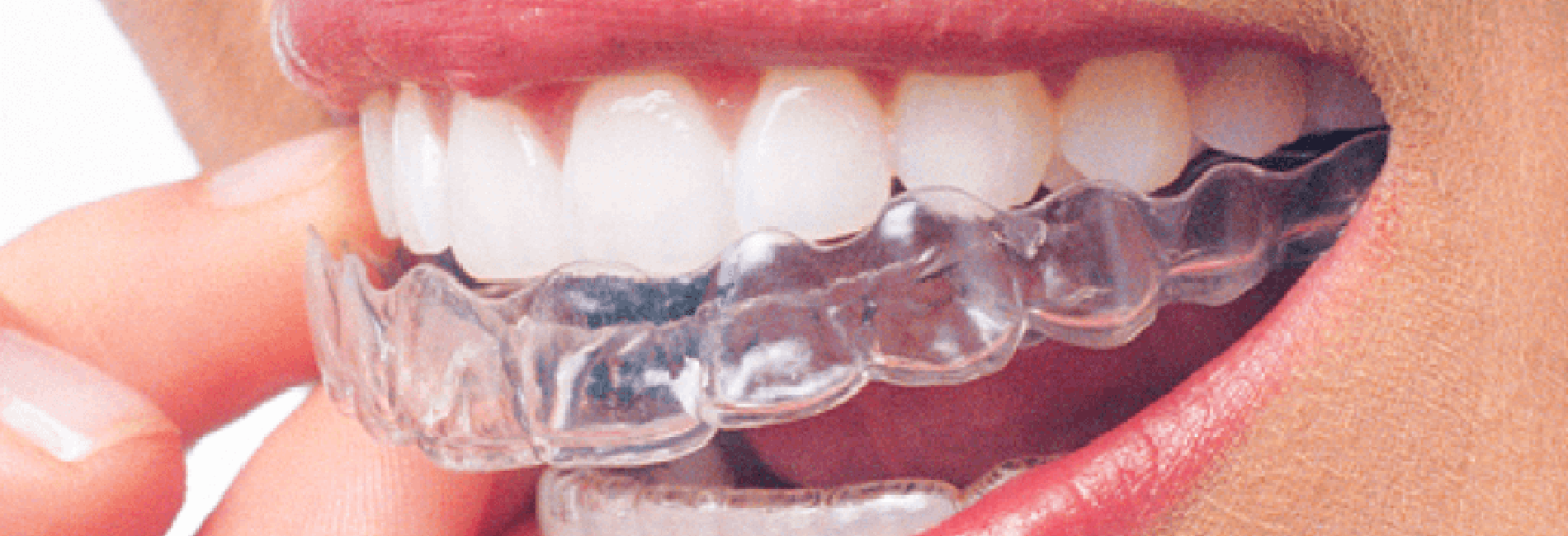 Invisalign®-Zahnschienen